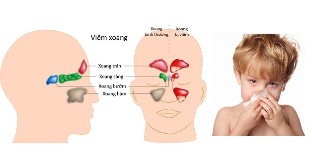 Viêm xoang mũi là bệnh lý tai mũi họng phổ biến ở trẻ em
